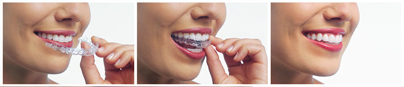 how-to-use-invisalign
